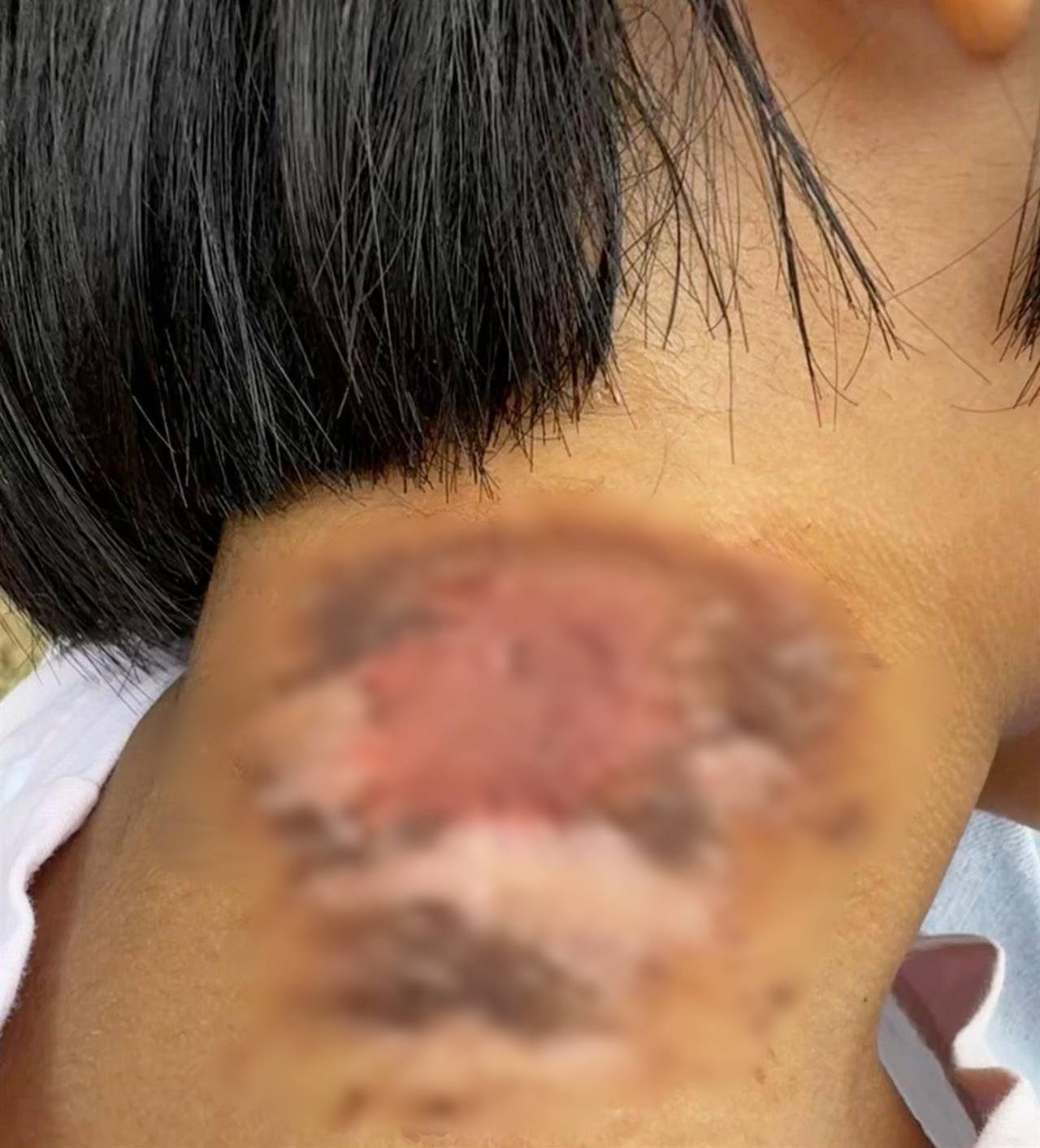 皇冠信用平台出租出售_河南多地现“行走的硫酸”:洛阳一工地脚手架密密麻麻全是皇冠信用平台出租出售,南阳4岁女童沾上它脖子红肿溃烂20余天未痊愈